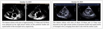 Case report: A case of blood culture-negative Bartonella quintana endocarditis: blood mNGS is an efficient method for early diagnosis